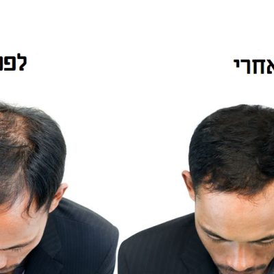 before and after bald head of a man on white background.