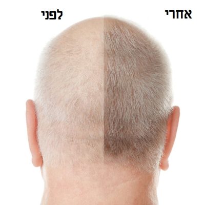 Senior man before and after hair loss treatment on white background