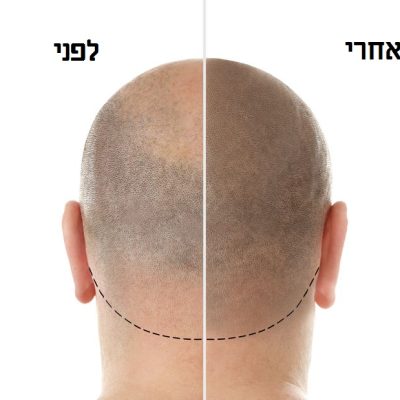 Man before and after hair loss treatment on white background