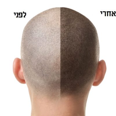 Man before and after hair loss treatment on white background