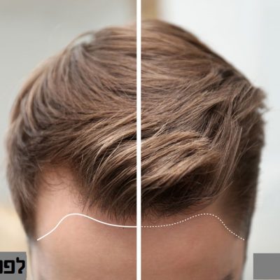 Young man before and after hair loss treatment against blurred background, closeup